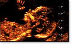 A typical obstetrical sonogram