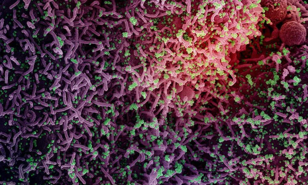 A colored electron micrograph of SARS-CoV-2, the agent of COVID (Corona Virua Disease)