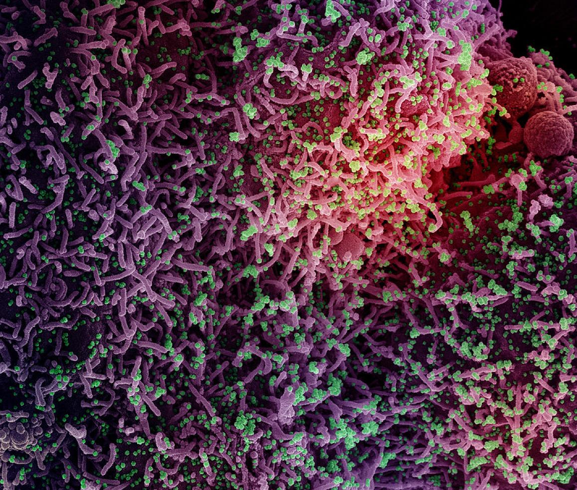 A colored electron micrograph of SARS-CoV-2, the agent of COVID (Corona Virua Disease)